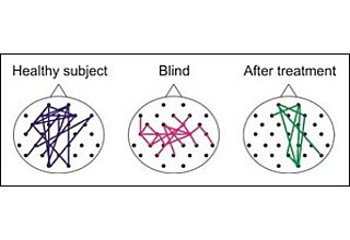 Schematische Darstellung der neuronalen Netzwerkverbindungen im Gehirn. Das Netzwerk im Gehirn von gesunden Probanden (links) ist charakterisiert durch lange Verbindungen zwischen dem Hinterkopf, also dem Bereich des Sehens (unterer Bereich der Kreise), und frontalen Regionen, die für kognitive Fähigkeiten zuständig sind (oberer Bereich der Kreise). Bei Personen, deren Sehkraft aufgrund einer Glaukom-Erkrankung oder einer Schädigung des Sehnervs eingeschränkt ist (Mitte), sind diese langen Verbindungen verloren gegangen. Ihr neuronales Netzwerk besteht vorwiegend aus kurzen Verbindungen in den zentralen Regionen des Gehirns. Eine Behandlung mit Wechselstrom (rechts) verbessert die visuellen Fähigkeiten von Teilerblindeten und unterstützt die Wiederherstellung einiger dieser langen Verbindungen.