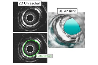 Illustration eines intravaskulären Ultraschalls mit extrahierter Gefäßwand und 3D Ansicht.